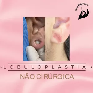 Imagem de capa para o Curso online Lobuloplastia Não Cirúrgica
