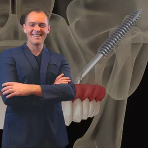 Imagem de Instalação de Implantes Zigomáticos com Anestesia Local: Curso Online criado por Simplificando a Implantodontia na hotmart