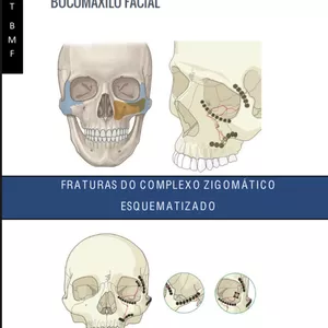 Imagem de capa para o Ebook Livro : Fraturas do Complexo Zigomático Esquematizado 
