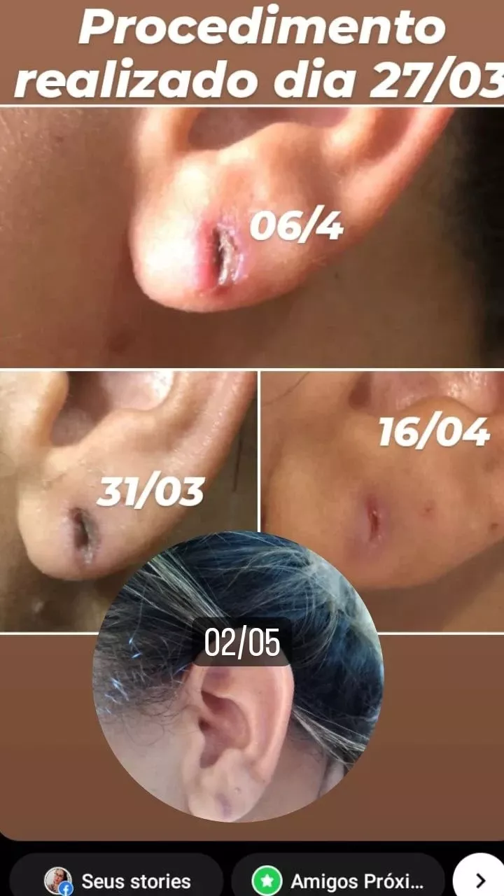 Curso de Lobuloplastia - Guia Completo para uma Reconstrução de Orelhas Rasgadas" — imagem 3