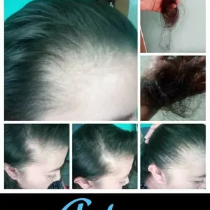 Imagen de portada para Curso online Tratamiento capilar para la caída del cabello