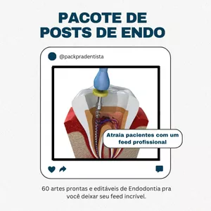 Pacote de Posts de Endodontia