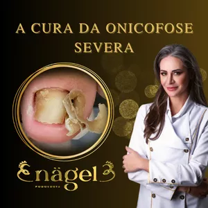 Imagem de capa para o Curso online A Cura da Onicofose Severa