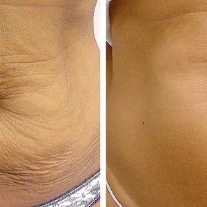 Imagen de portada para Curso online FLACIDEZ CERO 2.0