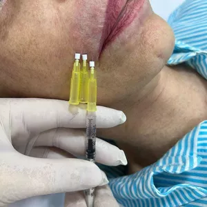 Imagem do curso NCTF+PDO Código de Barras - Rugas Periorais 