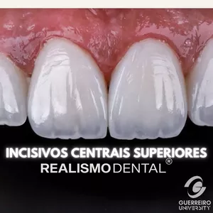 Imagem de capa para o Curso online Facetas em Resina - Realismo Dental® (INCISIVOS CENTRAIS SUPERIORES)