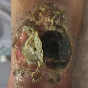 Imagem de capa para o Curso online MASTERCLASS DE CICATRIZAÇÃO DE FERIDAS NA PRÁTICA