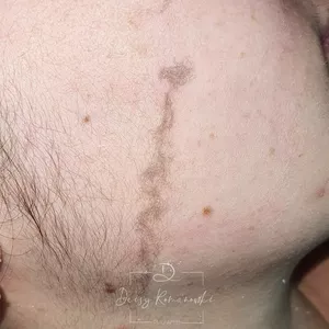 Imagem de capa para o Curso online Curso Dermaplaning - Técnica Pele de Pêssego
