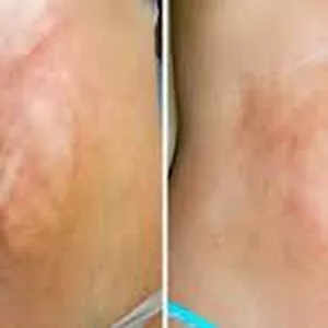 Imagen de portada para Curso online Clase: Tratamiento de Fibrosis