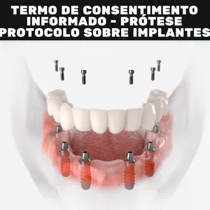 Imagem de capa para o Curso online Termo de Consentimento Informado - Prótese Protocolo sobre Implantes