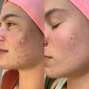 Cover image for Ebook 5 Things you need to know to treat your acne
