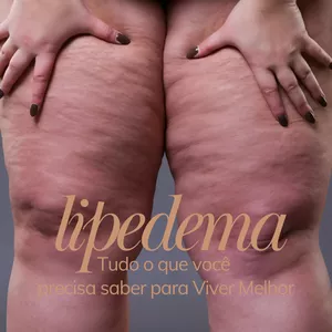 Imagem de capa para o Ebook Lipedema Tem Solução - Tudo o Que Você Precisa Saber para Viver Melhor