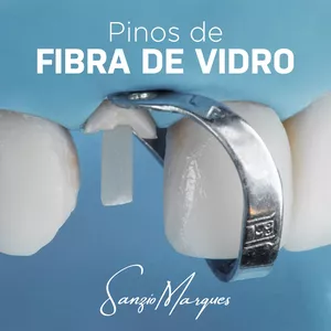 Imagem de capa para o Curso online Descomplicando os Pinos de Fibras de Vidro