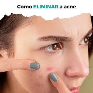 Imagem de capa para o Ebook Eliminando a Acne