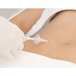 Imagem de capa para o Evento presencial CURSO DE CARBOXITERAPIA