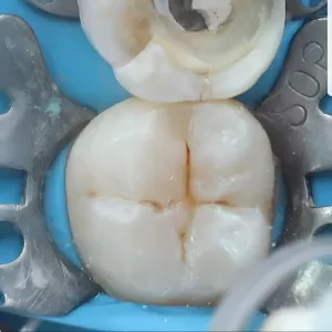 Imagem de capa para o Curso online Protocolo Completo de Dentes POSTERIORES