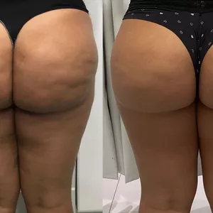 Imagen de portada para Curso online Adíos Celulitis