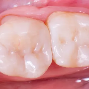 Imagem de capa para o Curso online Resinas em dentes Posteriores - Diretas e Indiretas!
