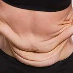 Imagen de portada para Ebook Flacidez Nunca Más