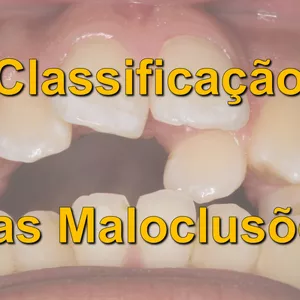 Imagem de capa para o Curso online Classificação das Más-oclusões