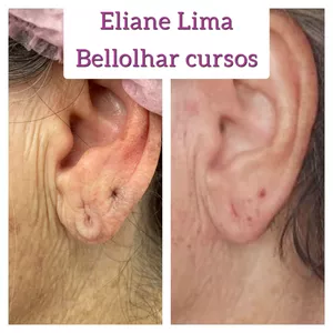 Imagem de capa para o Curso online Lobuloplastia não cirurgica (sem cortes) com jato de plasma