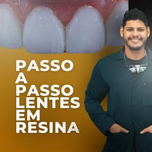 Passo a passo: Facetas em Resina>