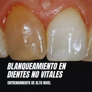 Imagen de portada para Curso online BLANQUEAMIENTO EN DIENTES NO VITALES