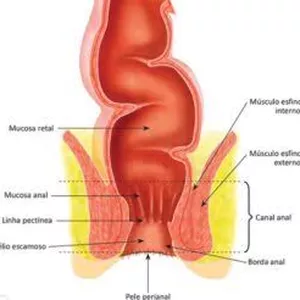 Imagem de capa para o Ebook Cura Hemorróida ou Fissura 