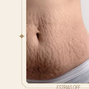 Imagen de portada para Ebook Como se  librar de estrias