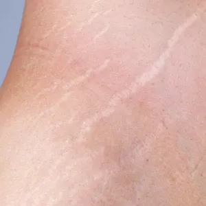 Cover image for Online course Stretch Mark Camouflage