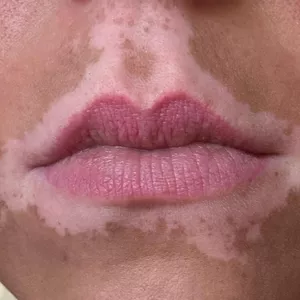 Imagem de capa para o Ebook Guia para o manejo eficaz do vitiligo