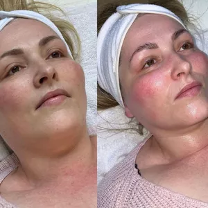 Imagen de portada para Curso online Curso de Drenaje Linfático Facial