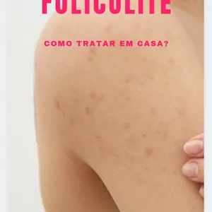 Imagem de capa para o Ebook E-book de Cuidados com a Foliculite em casa 