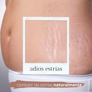 Imagen de portada para Curso online CÓMO BORRAR  LAS ESTRÍAS DE  FORMA NATURAL