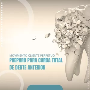 Imagem de capa para o Curso online MOVIMENTO CP - Preparo para coroa total de dente anterior.