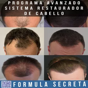 Imagen de portada para Ebook Programa Avanzado Sistema Restaurador de Cabello