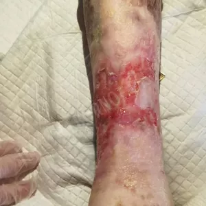 Imagen de portada para Curso online HERIDAS,ÚLCERAS cuidados en casa