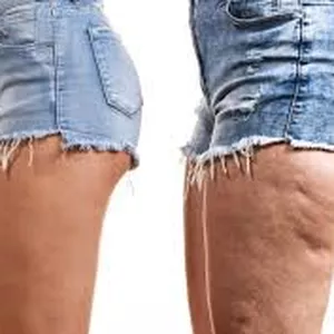 Imagen de portada para Curso online Celulitis Cero 