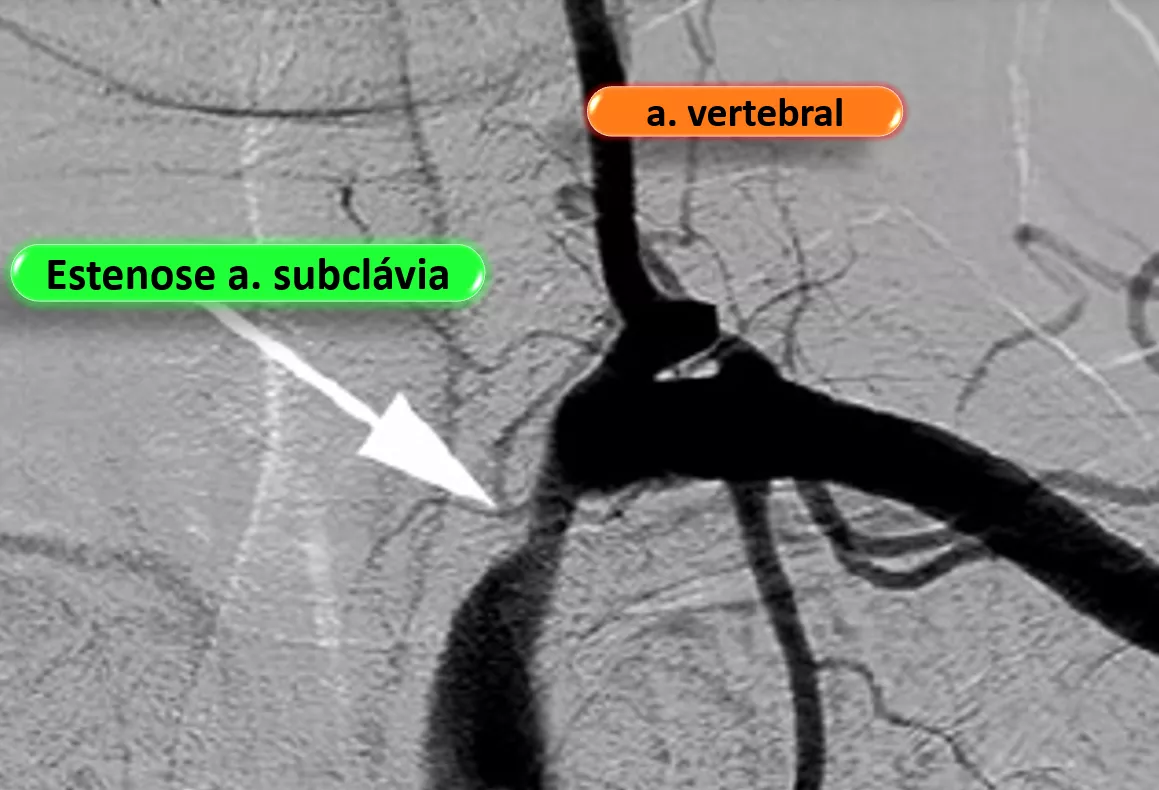 roubo da artéria subclávia 