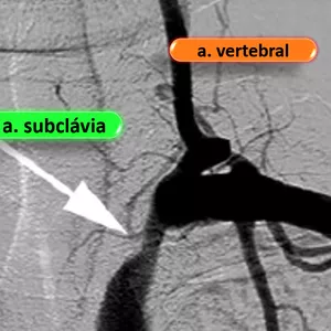 Imagem de capa para o Curso online Ultrassom Vascular com Doppler - Roubo da artéria subclávia