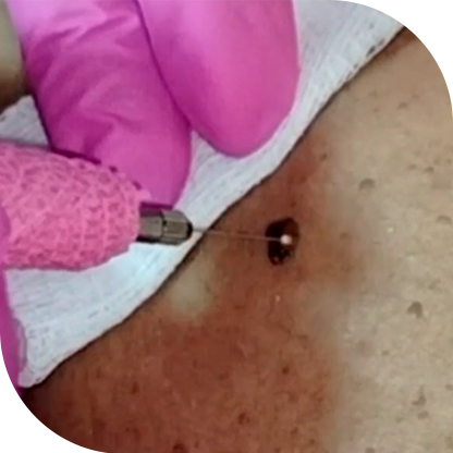 Cauterização de Verrugas