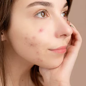Imagem de capa para o Curso online Acne Sob Controle: Explorando Causas e Tratamentos para uma Pele Radiante