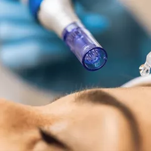 Imagem de capa para o Curso online Curso de Microagulhamento Master