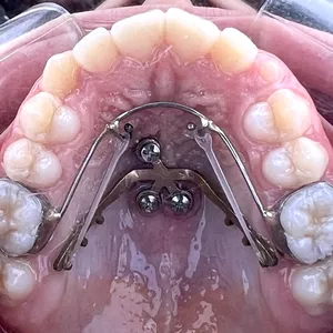 Imagem de capa para o Curso online Miniplaca Palatina Versátil (MPV)