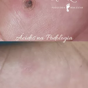Imagem de Podologia com ácidos criado por Profª. Esp. Aline Quintino na hotmart