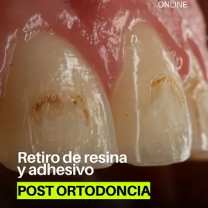 Imagen de portada para Curso online RETIRO DE RESINA Y ADHESIVO POST ORTODONCIA