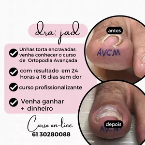 Imagem de capa para o Curso online curso para manicure/podologo/ enfermeiros DE ORTOPODIA AVANÇADA