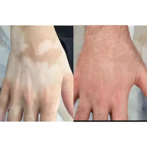 Imagen de portada para Curso online Dermopigmentación para Camuflar el Vitíligo