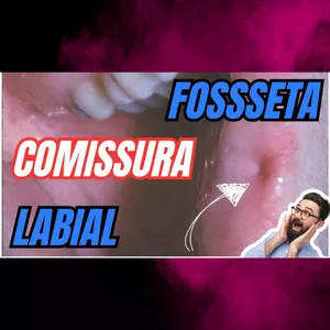 Imagem de capa para o Ebook PDF - Fosseta da comissura labial - Características clínicas, histológicas e tratamento -  Aula 3