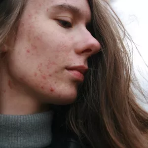 Imagen de portada para Curso online ACNÉFREE